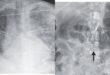 Kengerian Dokter, Cacing Parasit Muncul Setelah Transplantasi Ginjal!
