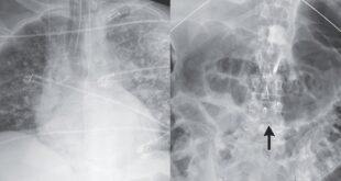 Kengerian Dokter, Cacing Parasit Muncul Setelah Transplantasi Ginjal!