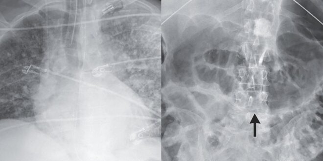 Kengerian Dokter, Cacing Parasit Muncul Setelah Transplantasi Ginjal!