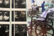 Kisah Pilu, Wanita 20 Tahun Lawan Kanker Usus, Awalnya Cuma Nyeri Perut Biasa?